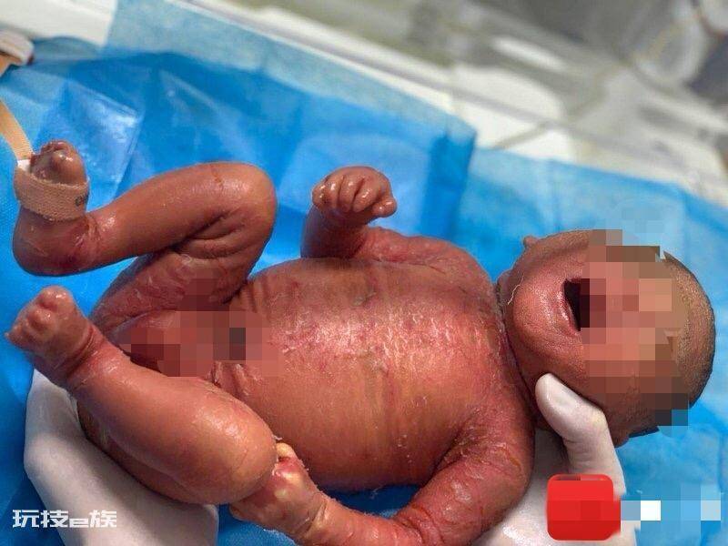 火棉胶婴儿是什么样子的(出现火棉胶婴儿到底是怎么回事)-图片1